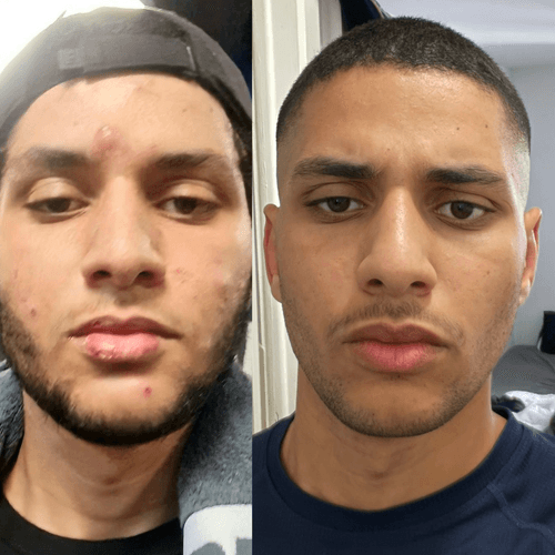 How TestoSecrets Helped Me Clear My Acne and Achieve Smooth, Healthy Skin